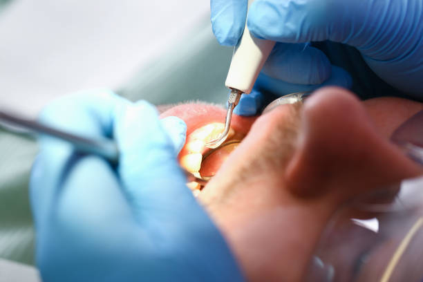 Best Emergency Root Canal Therapy in Woodward, IA