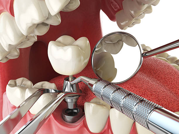 Best Knocked-Out Tooth (Avulsed Tooth) Treatment in Woodward, IA